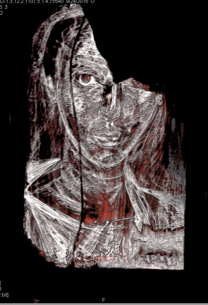CT of Works from the Hopkins Museum - CTisus CT Scan