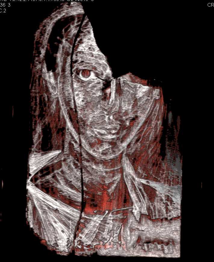 CT of Works from the Hopkins Museum - CTisus CT Scan